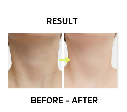 Intense Pulsed Light Wrinkle Reducing Instrument