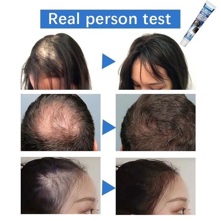 Sumifun Original Hair Growth Cream - Hair Loss Treatment for Thicker, Stronger Hair